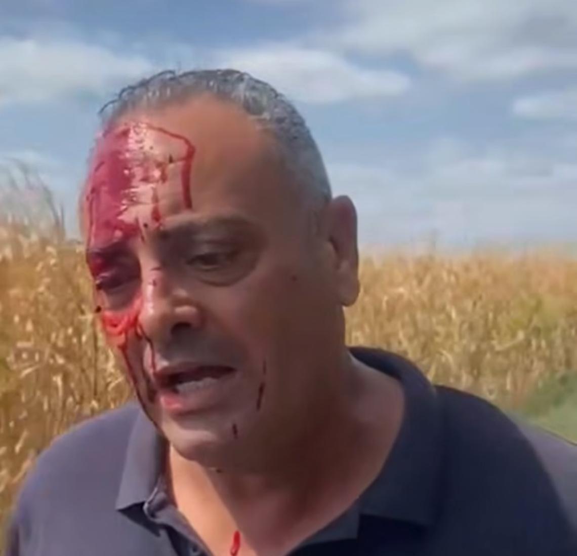Aggredito dal vicesindaco di un paese in Romania. Ferito un imprenditore pontino