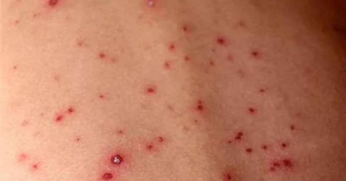 Morbillo, l&rsquo;allarme torna a salire: pi&ugrave; casi e pi&ugrave; complicanze anche nel Lazio