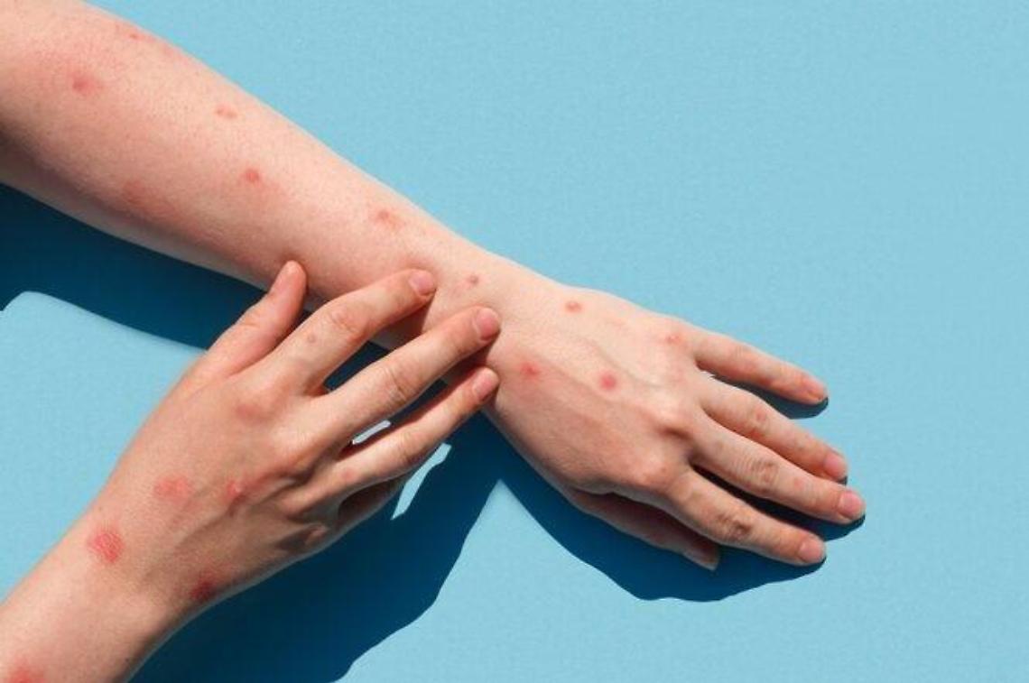 Vaiolo delle scimmie, inizia la campagna vaccinale. Ecco chi deve farlo