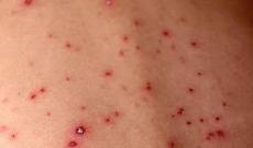 Morbillo, l&rsquo;allarme torna a salire: pi&ugrave; casi e pi&ugrave; complicanze anche nel Lazio