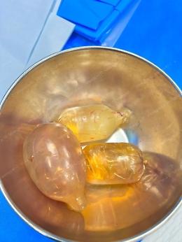 Ovuli di cocaina bloccati nell'intestino, colombiano operato nella notte in stato di arresto
