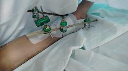 Nella buca col monopattino, 20enne di Latina si spezza il piede