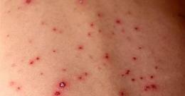 Morbillo, l&rsquo;allarme torna a salire: pi&ugrave; casi e pi&ugrave; complicanze anche nel Lazio