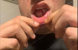 Brutale aggressione in strada,  il bullo gli frattura la mascella  