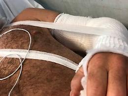 Sub travolto da un gommone rimane ferito, l'appello dall'ospedale