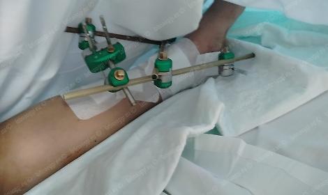 Nella buca col monopattino, 20enne di Latina si spezza il piede