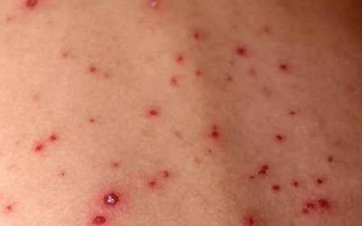 Morbillo, l&rsquo;allarme torna a salire: pi&ugrave; casi e pi&ugrave; complicanze anche nel Lazio